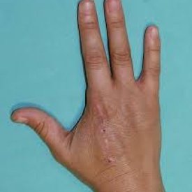Amputation of the Index Finger