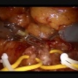Robot-Assisted Partial Nephrectomy Enhanced