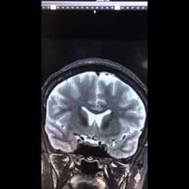 Hippocampal Malrotation – Head MRI