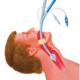 Oesophageal Intubation