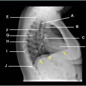 Pneumonia Radiologic Anatomy