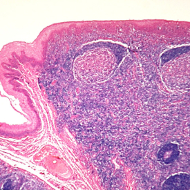 Histology of Lingual Tonsil