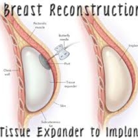 What is Breast Reconstruction?
