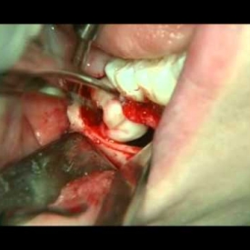Follicular Cyst in Posterior Mandible