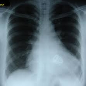 Chest X-ray: Aortic & Mitral Valve