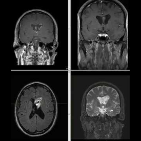 Hydrocephalus – Head MRI