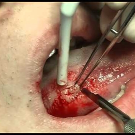 Excisional Biopsy of the Lateral Border of the Tongue