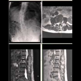 Lumbar Spine – Typical MRI Interpretation