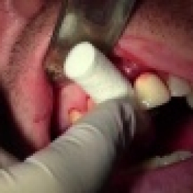 Extraction #8 With Socket Grafting II