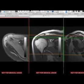 Systematic Interpretation Of Shoulder MRI