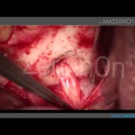 Odontogenic Mandibular Cyst