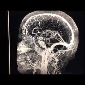 Angiogram Of The Head – Time Resolved MRI