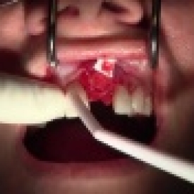 Extraction #9 with GBR-Socket Grafting
