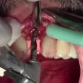 Klipod Recording Of Dental Implant Surgery