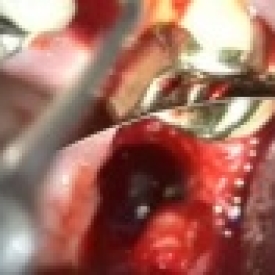 Dental Implant Microsurgery