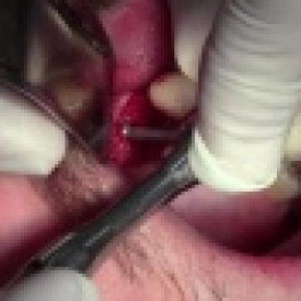 Implant Surgery #6