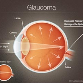 3D Glaucoma Surgery