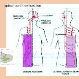 hemisection of the spinal cord