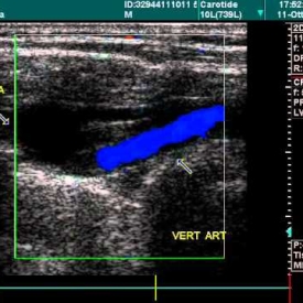 Vertebral Artery, Doppler Echography