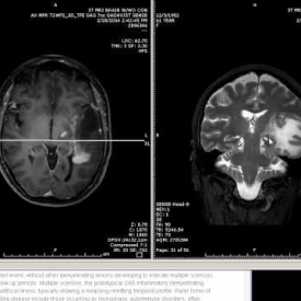 Primary Brain Tumor And Homonymous Hemianopsia