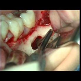 Surgical Removal of a Simple Bone Cyst