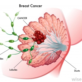 Spread of prostate cancer