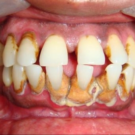 Periodontal Disease and Respiratory Infections