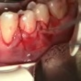 Covering Recession Caused By Root Resorption