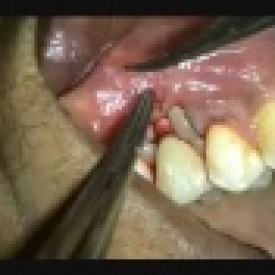 AlloDerm Root Coverage Grafting