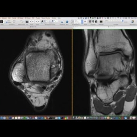 Systematic Interpretation Of Ankle MRI