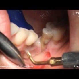 Piezosurgery – Distraction Ostegenesis (Molar)
