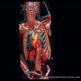 Whole Body CT Scan