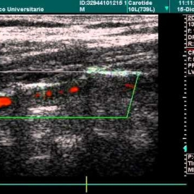 Vertebral Artery In Doppler Examination
