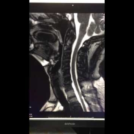 Valsalva Maneuver – Dynamic Neck MRI