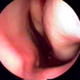 Nasal Endoscopy
