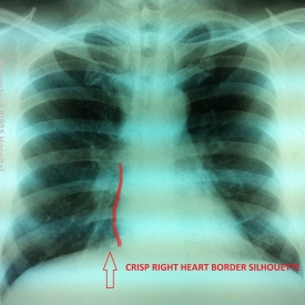 Chest X-ray: Silhouette Sign