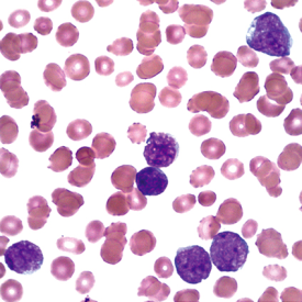 Chronic Myelogenous Leukemia