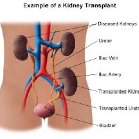 Kidney Transpalantation