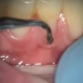 Poorly Fabricated Dental Fillings Correction