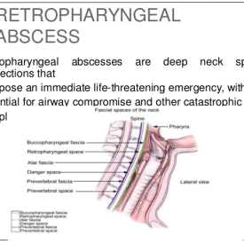 Retropharyngeal abscess