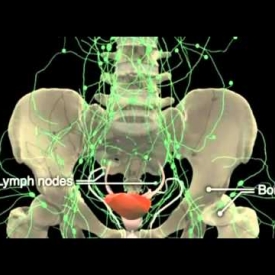 How Prostate Cancer Develops in Prostate Gland