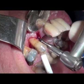 Implant Microsurgery: Failing Implant Site Repair