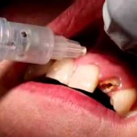 Labial infiltration