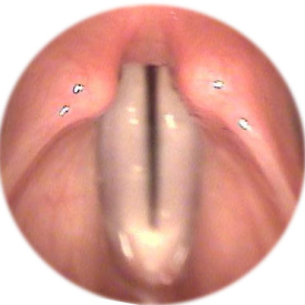 Endoscopic Vocal Cords