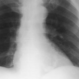 Chest X-ray: Mitral Valve Calcification