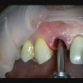 Immediate Implant Upper Lateral