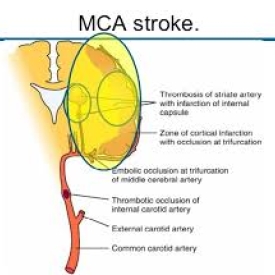 Middle cerebral artery stroke – Axiom Neuro 3D Neurology and Neuroanatomy
