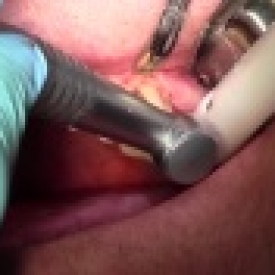 Clinical Crown Lengthening #14