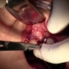 Extraction #7 with Socket Grafting
