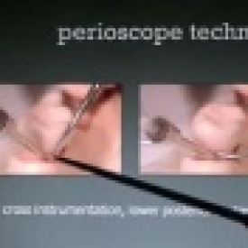 Technique of Perioscopy